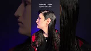 Пластика лба (фронтопластика) 31