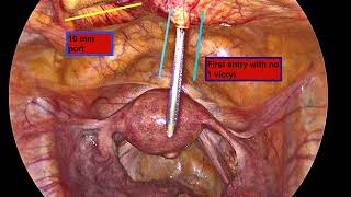 Laparoscopic Port Closure | Dr Kunal Rathod