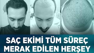 Saç Ekimi Süreci & Merak Edilenler - Hair Transplant Process & Eveythi