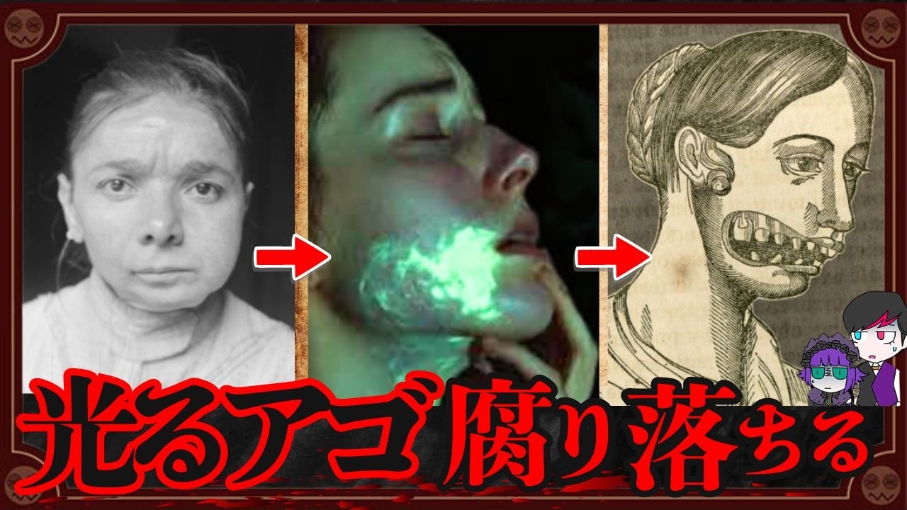 【閲覧注意】顔面が緑に光る少女たち…最後はアゴが腐り落ちた