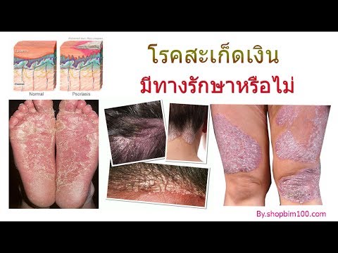 หัว moknet ในโรคผิวหนังภูมิแพ้ วันในน้ำที่มีโรคสะเก็ดเงิน