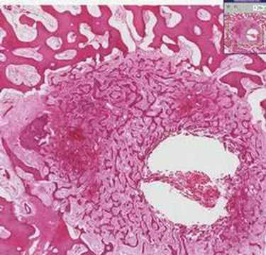 Histopathology Bone--Osteoid osteoma