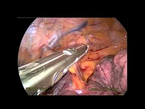 Torakoskopowa operacja skrętu przewodu z żołądka
