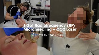 Everything You Need To Know About Radiofrequency (RF) Microneedling and CO2 Fractional Laser