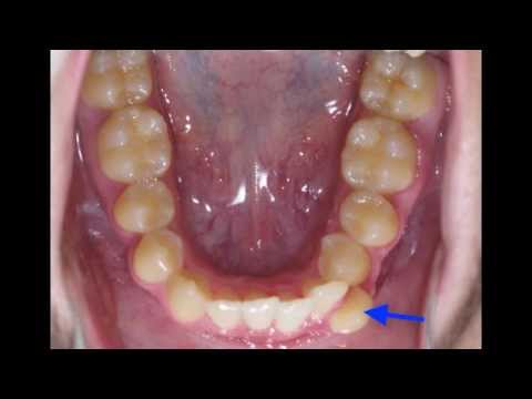 Lower Crowding Non Extraction: Kyger Orthodontics