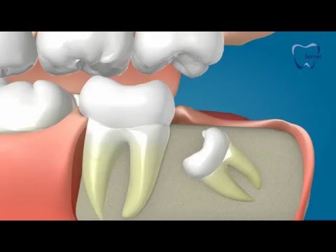 Dientes que necesitan extraccion