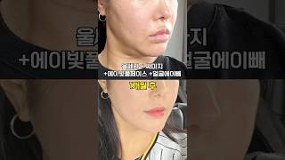 탄력이랑 윤곽 잡아주는 시술