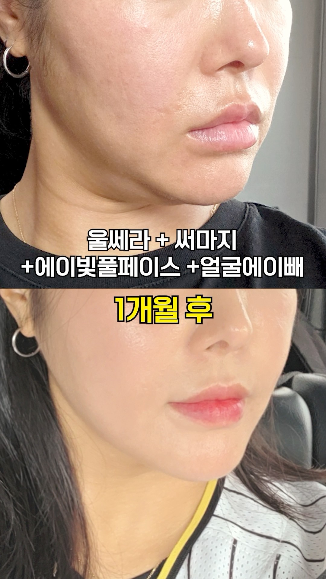 탄력이랑 윤곽 잡아주는 시술