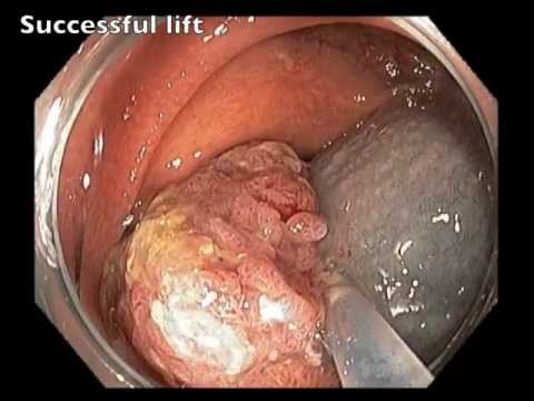 EMR of Giant Sessile Polyp in Ascending colon