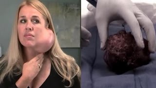 Cancer Symptoms Everyone Ignores