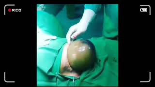 Cesarean delivery / c-section : Surgical technique - HD Video