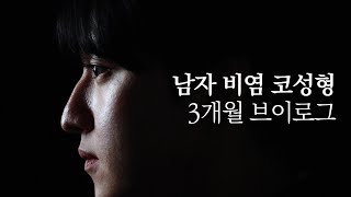 남자 비염 코성형 3개월 브이로그 | 무보형물 코성형, 휜코성형, 매부리코개선, 코끝처짐개선, 비염개선 | 첫단추 코성형클리닉