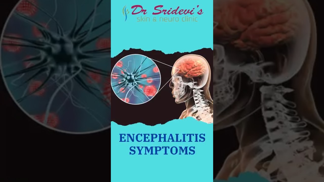 Epilepsy Treatment Explained