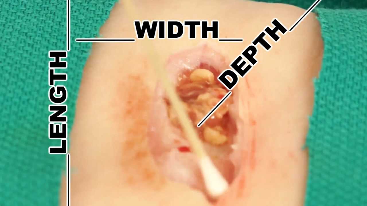 Wound Measurement- Understand Wound Care - YouTube
