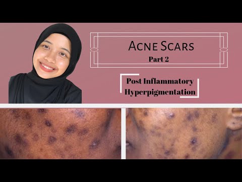 Acne Scars Part 2 - Post Inflammatory Hyperpigmentation
