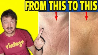Getting Rid Of Chest Wrinkles And Vertical Lines