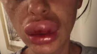 Lip Injection at ‘Botox Party’ Goes Horribly Wrong