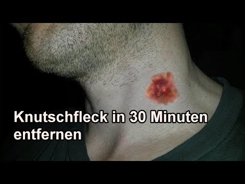 Pool in der Behandlung von Rücken Arthritis der kleinen Gelenke der Hände und Füße Behandlung