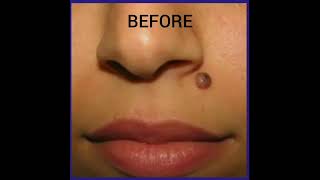 Download lagu MOLE REMOVAL (Laser / surgical) mp3