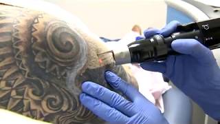preview picture of video 'Picosure Laser Tattoo Removal - See It Work Up Close'
