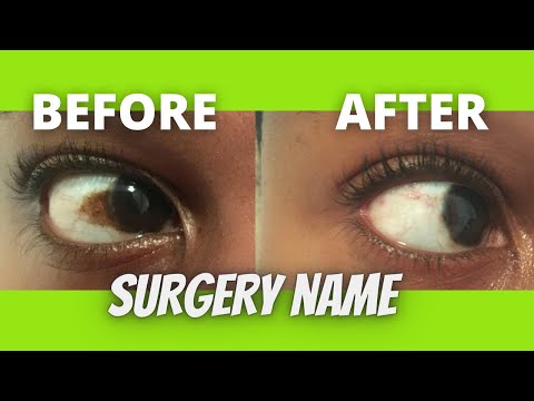 Eye brown spot | Discolouration | Pigment | Freckle |...