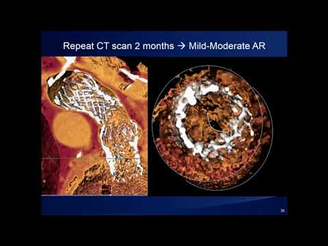 How I Managed a Difficult CoreValve TAVR Case - Jeffrey Popma, MD