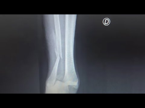 Macba Life - "Not like before, but I can Skate". Gabriel Ribeiro