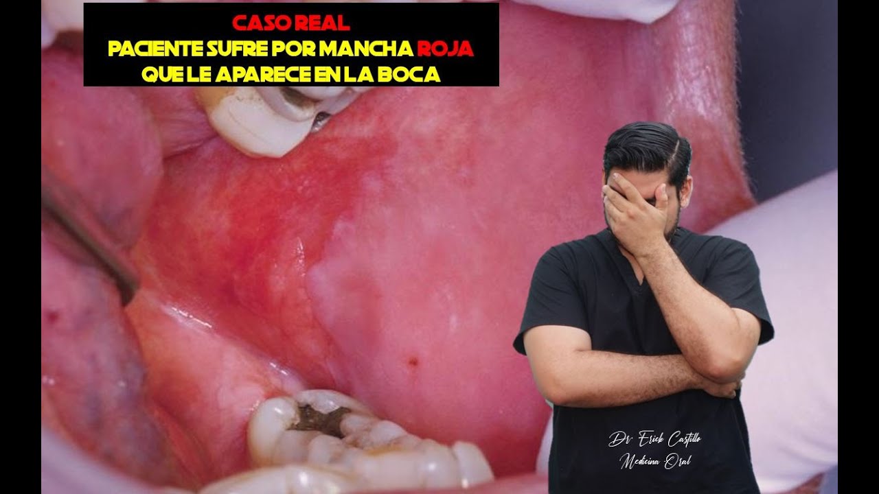 Discusión de casos ¿Qué es esa mancha roja en mi boca 
