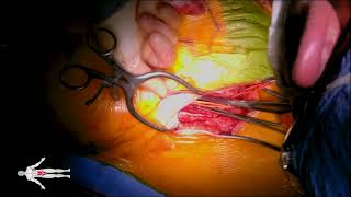 Download Lagu Thoracofemoral Bypass Maham Rahimi, MD, and Edward Andraos, MD Thumbnail