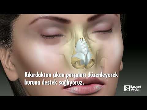 Rinoplasti ameliyatı nasıl yapılır? Rinoplasti açık burun estetiği