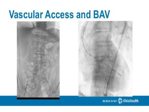 Valve choice made the difference_Yakubov_Structural On Demand