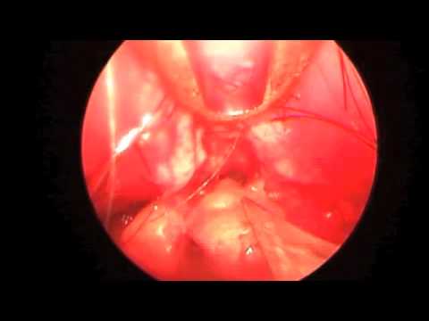 Endoscopic Removal of Forehead Lipoma