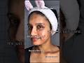 “Clear Skin Transformation – Acne ➜ Glow”