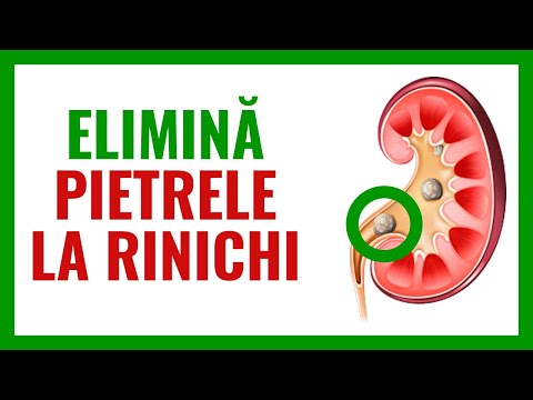 lily tinctura de varicoza decât tratai varicoza dupa natere