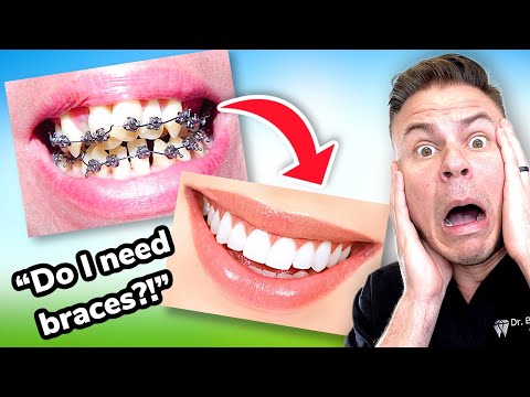How To Tell If You Need BRACES! The ULTIMATE Braces Guide Ep. 1