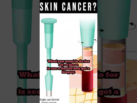 Skin Tag Removal Wart Removal How To Get Rid Of Skin Tags Warts