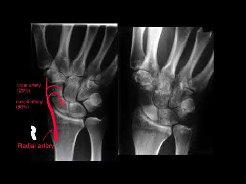 Scaphoid fracture - why knowing your anatomy is so important