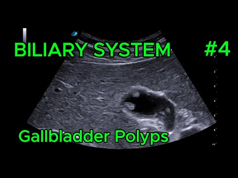 Adenomyoma video preview