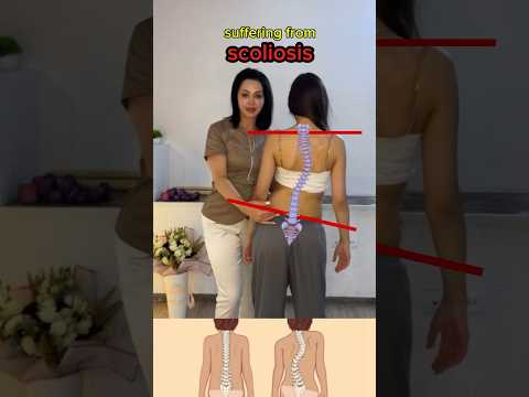 Essential exercise for managing scoliosis. strengthen your core and improve spinal health #scoliosis