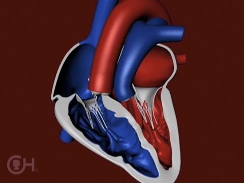 The Structure of a Heart with Transposition of the Great Arteries (TGA) - CHOP