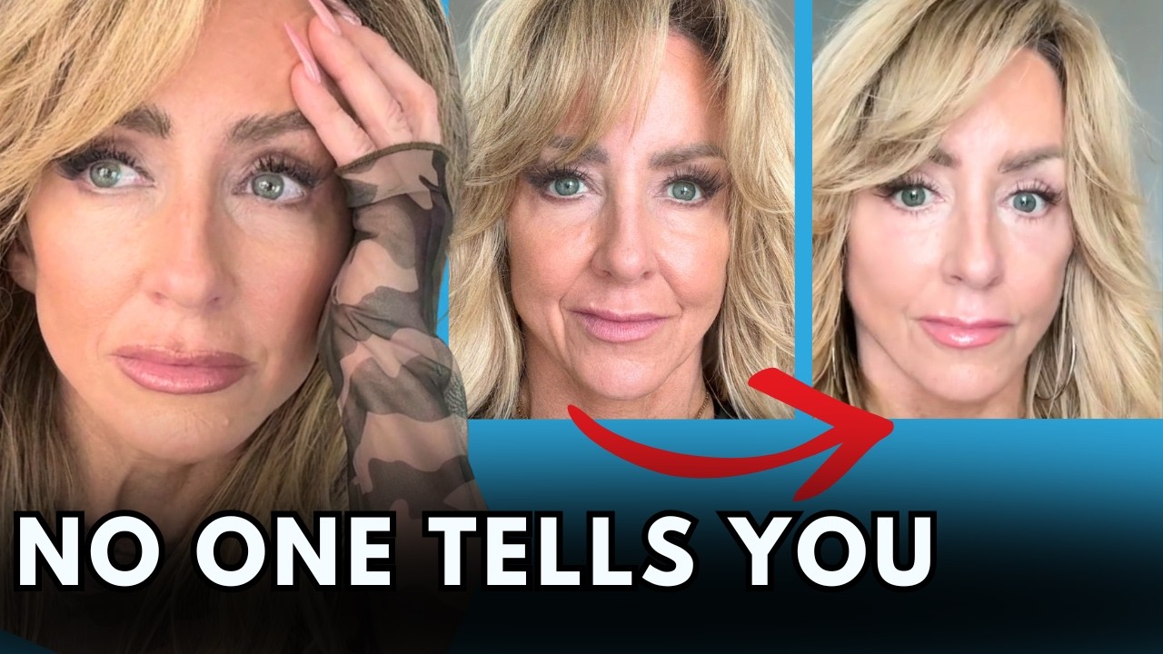 My Deep Plane Facelift Regrets and Honest Results