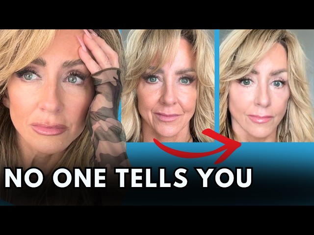 My Deep Plane Facelift Regrets and Honest Results SDDEFAULT Thumbnail