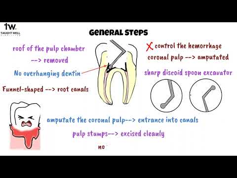 Pulpotomy: The Ultimate Guide for Dental Students | Master the Procedure Like a Pro