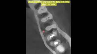 How to manage a totally sclerotic root canal.