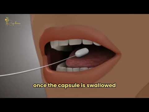 Gastric Balloon Video