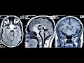 CYSTIC CRANIOPHARYNGIOMA-NAVIGATION GUIDED ASPIRATION AND RESERVOIR PLACEMENT-dr suresh dugani/INDIA