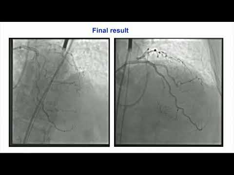 CVI 2019_Thursday, 7/18_ Coronary Challenging Case Competition Semifinals_Michael Megaly, MD, MS