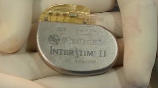 preview picture of video 'Interstim Sacral Neuromodulation by Dr Anup Gulati'