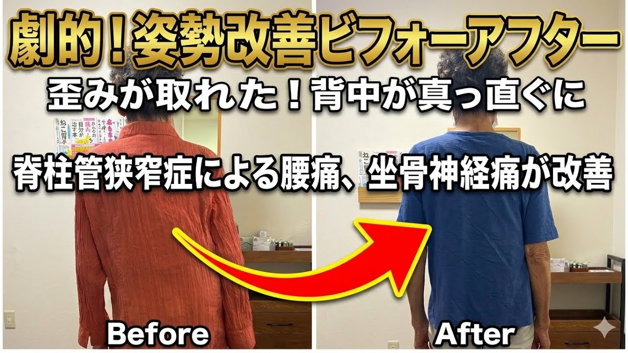 【脊柱管狭窄症•側湾】歪みが取れて腰やお尻の痛みも改善✨大阪の西住之江鍼灸整体院