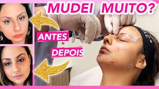 Harmonização Facial com Ácido Hialurônico - Preenchimento Antes e Depois - Quanto Custa Dói muito